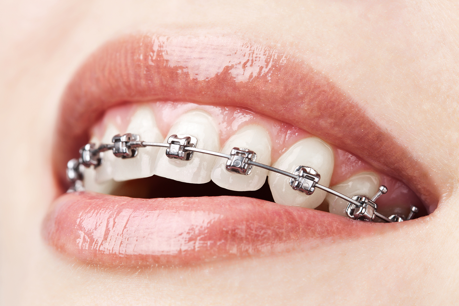 The Synergy of Braces & Myofunctional Therapy in Portland, OR: A Comprehensive Approach to Oral Health